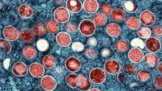 A microscopic image of mpox virus particles. Photo courtesy of the CDC/National Institute of Allergy and Infectious Diseases (NIAID).